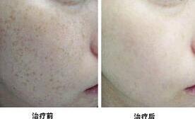 清遠雀斑價格