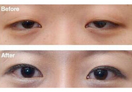 白銀眼瞼下垂矯正價格