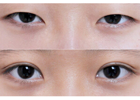 白銀眼瞼粘連術價格