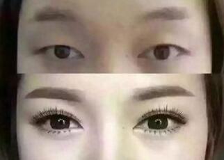 广州粤秀双眼皮要注意什么？