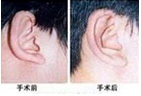 莆田招風耳矯正價格