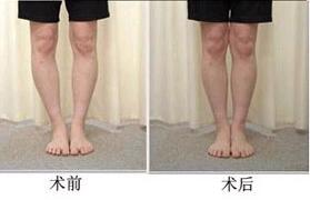 莆田O型腿矯正價格