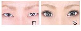 三明瞼眶溝填充價格