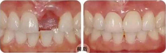 白銀種植牙價(jià)格