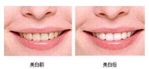清遠牙齒美白價格
