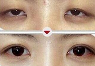 泉州瞼眶溝填充價格