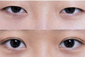 泉州眼部綜合術價格