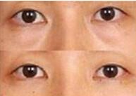 泉州眼瞼粘連術價格