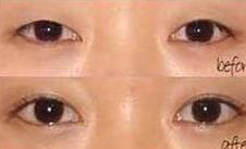 泉州眼瞼病損切除術(shù)價格