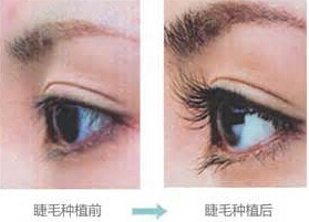 嘉峪關(guān)睫毛種植價(jià)格
