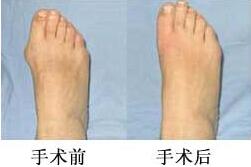 三明拇外翻（大腳骨）矯正價格