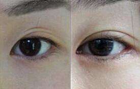 漳州雙眼皮失敗修復(fù)價格