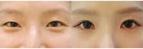 漳州眼瞼下垂矯正價(jià)格