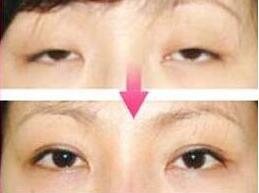 漳州下瞼外翻矯正價格