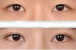 漳州眼瞼缺損局部皮瓣修復價格