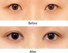 漳州眼瞼病損切除術價格