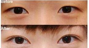 天水眼瞼下垂矯正價格