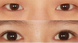 漳州眼瞼粘連術價格