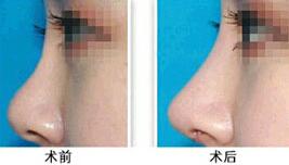 漳州隆鼻價(jià)格
