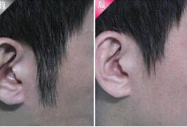 漳州發際線脫毛價格