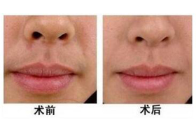 天水脫唇毛價格