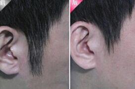 天水發際線脫毛價格