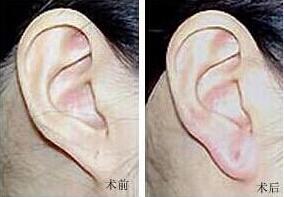 漳州耳垂加大價格