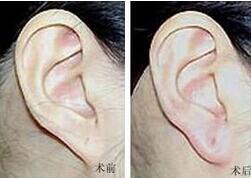 漳州穿耳孔價格
