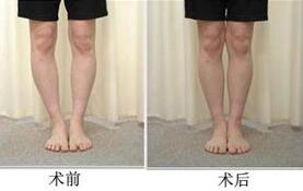 漳州O型腿矯正價(jià)格