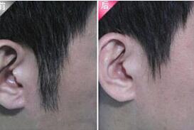 龍巖發際線脫毛價格