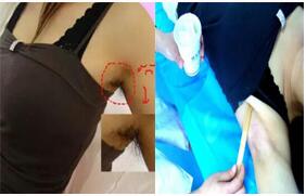 蕪湖激光脫腋毛價格