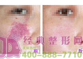 鹽城鮮紅斑痣價格