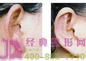 鹽城菜花耳整形價格