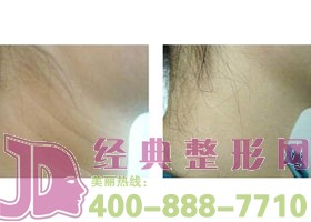 鹽城電波拉皮價格