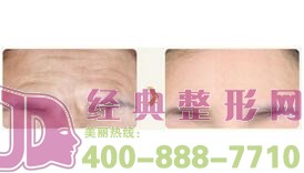鹽城去除抬頭紋價(jià)格