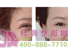 鹽城眼部除皺價格