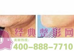 鹽城頸部除皺價格