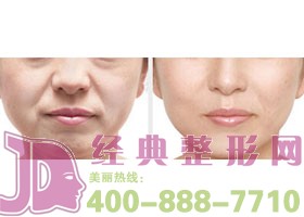 鹽城膠原蛋白除皺價格