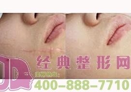 激光祛疤存在风险吗？