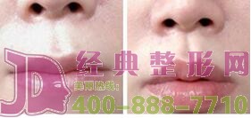 蕪湖薄唇增厚價格