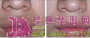 蕪湖重唇整形價格