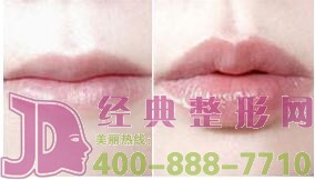 蕪湖露齦笑整形價格