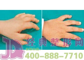 鹽城多指趾畸形矯正價格