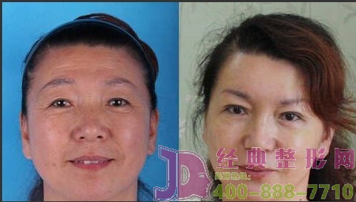 泰州上瞼凹陷填充價格