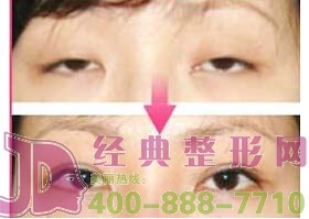 泰州眼瞼外翻整復價格