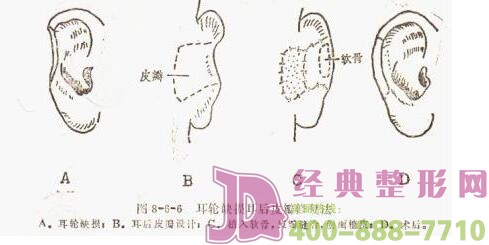 耳轮缺损修复术能变得完好如初吗？