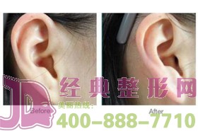 泰州招風耳矯正價格