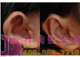 泰州耳垂再造價格