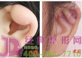 泰州耳垂畸形修復(fù)價(jià)格
