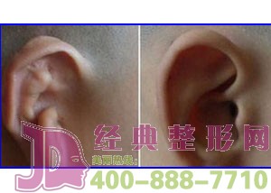 泰州隱耳整形價格